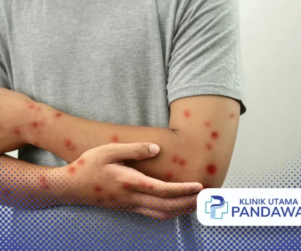 cara mencegah cacar air agar tidak bertambah banyak