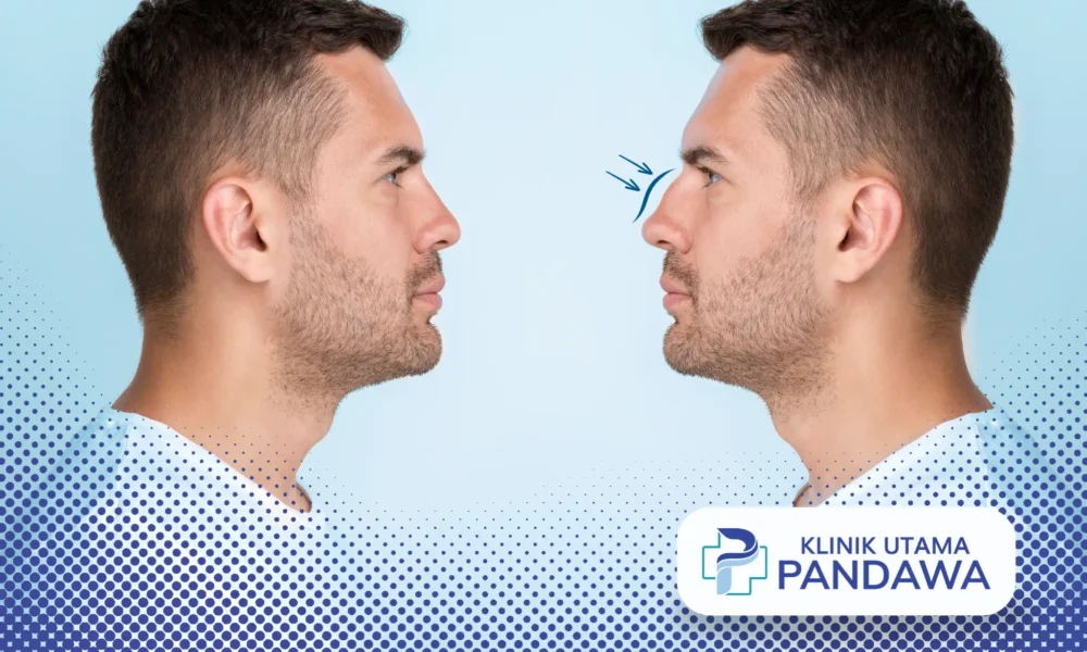 perbedaan hidung mancung dan pesek