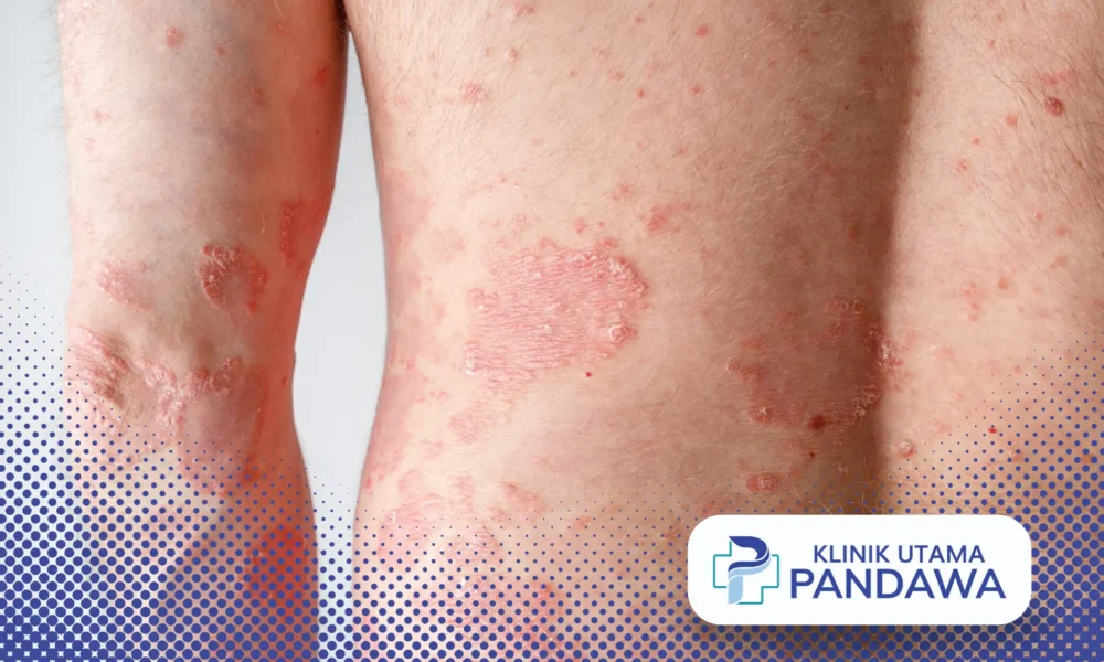 Pengobatan ptyriasis rosea