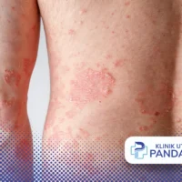 Pengobatan ptyriasis rosea