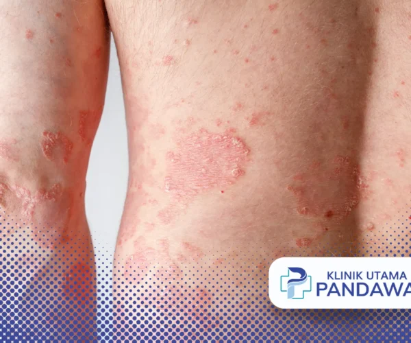 Pengobatan ptyriasis rosea