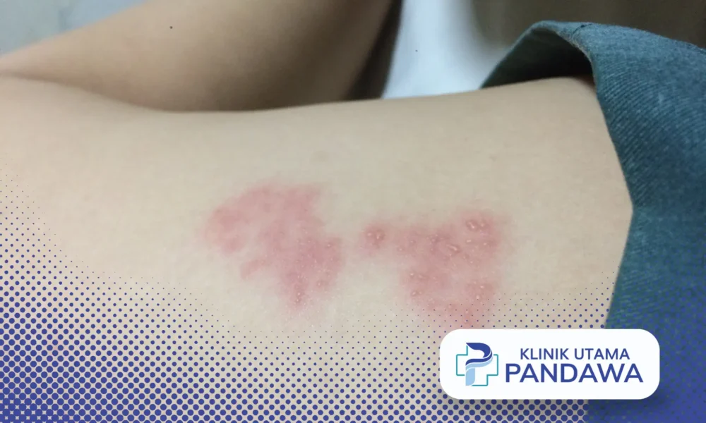 agar herpes cepat kering