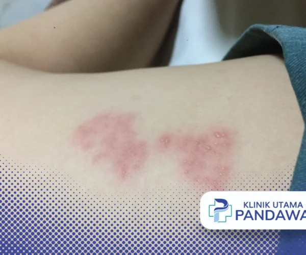 agar herpes cepat kering