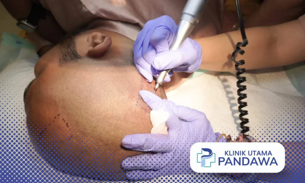 biaya hair transplant