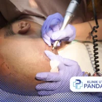 biaya hair transplant
