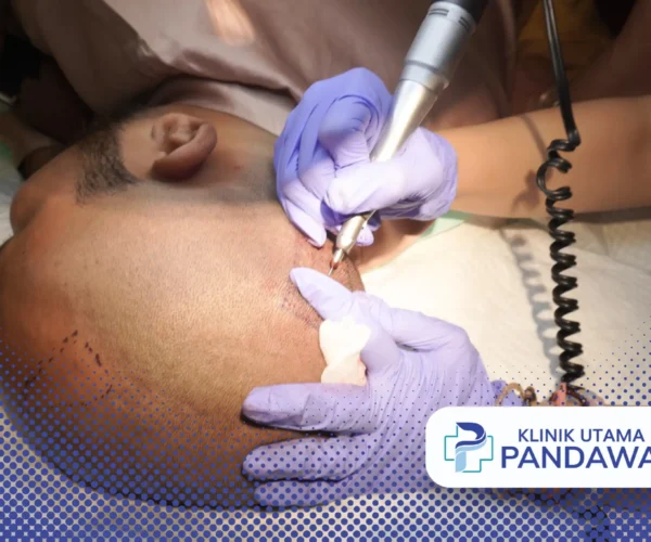 biaya hair transplant