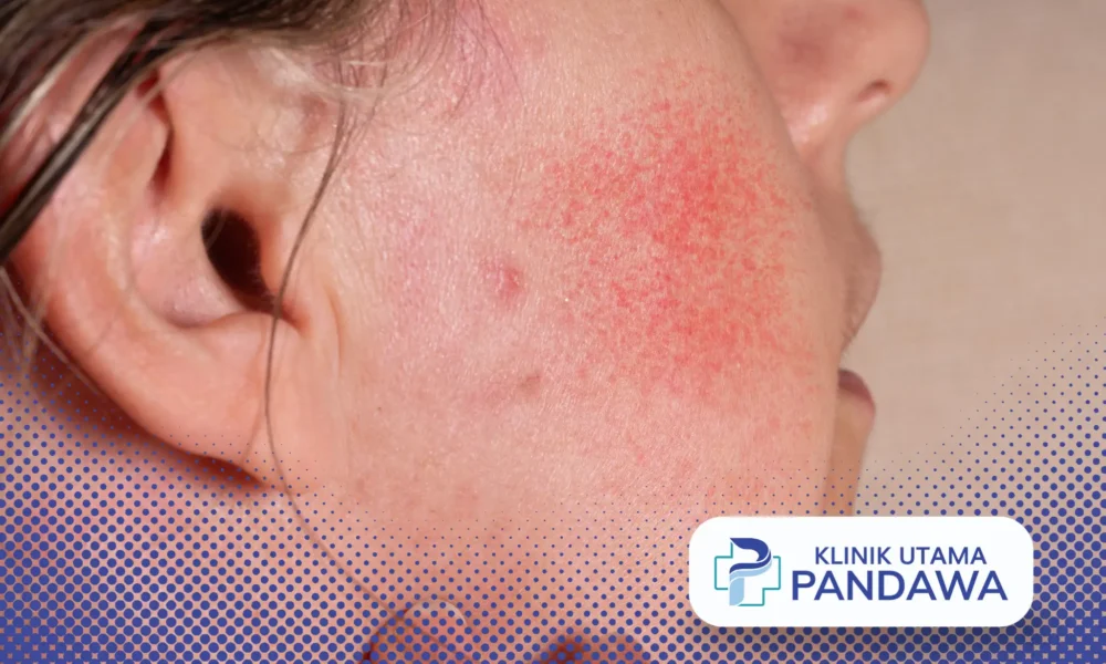 cara mengobati herpes di wajah