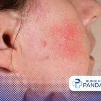 cara mengobati herpes di wajah