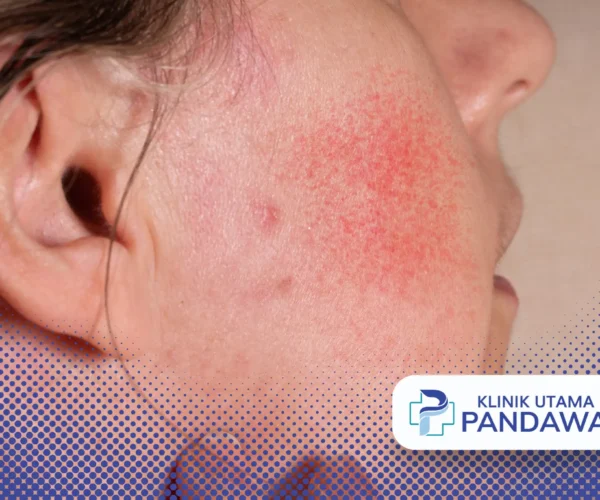 cara mengobati herpes di wajah